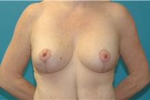 Breast Lift After Photo by Scott Sattler, MD,  FACS; Seattle, WA - Case 47245