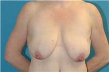 Breast Lift Before Photo by Scott Sattler, MD,  FACS; Seattle, WA - Case 47245