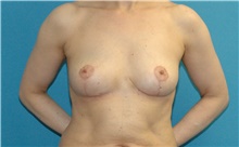 Breast Implant Removal After Photo by Scott Sattler, MD,  FACS; Seattle, WA - Case 47248