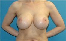 Breast Implant Removal Before Photo by Scott Sattler, MD,  FACS; Seattle, WA - Case 47248