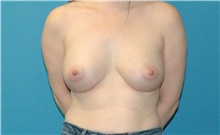 Breast Augmentation After Photo by Scott Sattler, MD,  FACS; Seattle, WA - Case 47255
