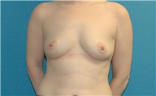 Breast Augmentation Before Photo by Scott Sattler, MD,  FACS; Seattle, WA - Case 47255