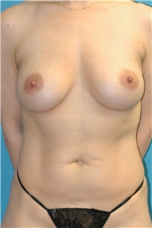 Breast Implant Removal Before Photo by Scott Sattler, MD,  FACS; Seattle, WA - Case 47826