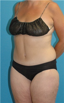 Tummy Tuck After Photo by Scott Sattler, MD,  FACS; Seattle, WA - Case 47827