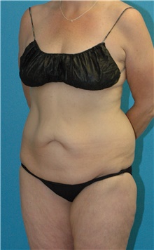 Tummy Tuck Before Photo by Scott Sattler, MD,  FACS; Seattle, WA - Case 47827