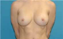 Breast Augmentation After Photo by Scott Sattler, MD,  FACS; Seattle, WA - Case 47878