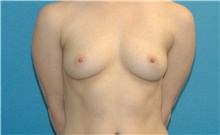 Breast Augmentation Before Photo by Scott Sattler, MD,  FACS; Seattle, WA - Case 47878