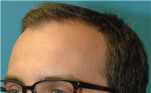 Hair Transplant Before Photo by Scott Sattler, MD,  FACS; Seattle, WA - Case 47879