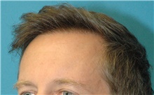 Hair Transplant After Photo by Scott Sattler, MD,  FACS; Seattle, WA - Case 47886