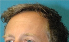 Hair Transplant Before Photo by Scott Sattler, MD,  FACS; Seattle, WA - Case 47886