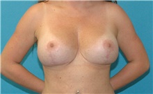 Breast Implant Revision After Photo by Scott Sattler, MD,  FACS; Seattle, WA - Case 47892