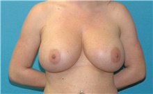 Breast Implant Revision Before Photo by Scott Sattler, MD,  FACS; Seattle, WA - Case 47892