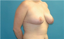 Breast Reduction After Photo by Scott Sattler, MD,  FACS; Seattle, WA - Case 47904