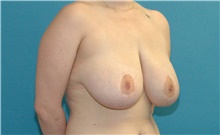 Breast Reduction Before Photo by Scott Sattler, MD,  FACS; Seattle, WA - Case 47904