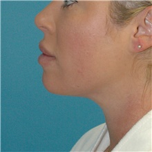 Liposuction After Photo by Scott Sattler, MD,  FACS; Seattle, WA - Case 47910