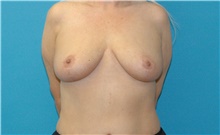 Breast Lift After Photo by Scott Sattler, MD,  FACS; Seattle, WA - Case 47912