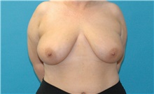 Breast Lift Before Photo by Scott Sattler, MD,  FACS; Seattle, WA - Case 47912