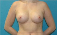 Breast Augmentation After Photo by Scott Sattler, MD,  FACS; Seattle, WA - Case 47932