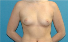 Breast Augmentation Before Photo by Scott Sattler, MD,  FACS; Seattle, WA - Case 47932