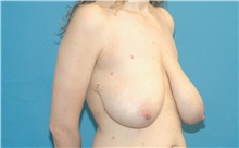 Breast Reduction Before Photo by Scott Sattler, MD,  FACS; Seattle, WA - Case 47933