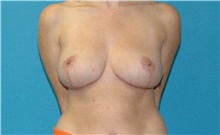 Breast Reduction After Photo by Scott Sattler, MD,  FACS; Seattle, WA - Case 48557