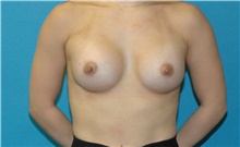 Breast Augmentation After Photo by Scott Sattler, MD,  FACS; Seattle, WA - Case 48649