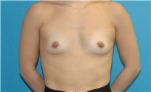 Breast Augmentation Before Photo by Scott Sattler, MD,  FACS; Seattle, WA - Case 48649