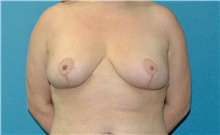 Breast Reduction After Photo by Scott Sattler, MD,  FACS; Seattle, WA - Case 48793