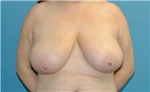 Breast Reduction Before Photo by Scott Sattler, MD,  FACS; Seattle, WA - Case 48793