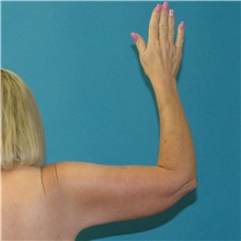 Arm Lift After Photo by Scott Sattler, MD,  FACS; Seattle, WA - Case 49038