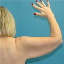 Arm Lift Before Photo by Scott Sattler, MD,  FACS; Seattle, WA - Case 49038