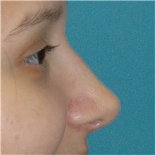 Rhinoplasty After Photo by Scott Sattler, MD,  FACS; Seattle, WA - Case 49057