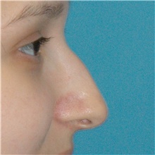 Rhinoplasty Before Photo by Scott Sattler, MD,  FACS; Seattle, WA - Case 49057