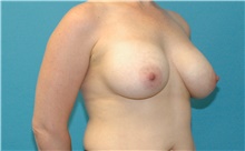 Breast Augmentation After Photo by Scott Sattler, MD,  FACS; Seattle, WA - Case 49064