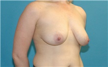 Breast Augmentation Before Photo by Scott Sattler, MD,  FACS; Seattle, WA - Case 49064