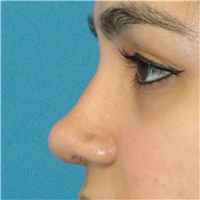 Rhinoplasty After Photo by Scott Sattler, MD,  FACS; Seattle, WA - Case 49115