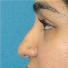 Rhinoplasty Before Photo by Scott Sattler, MD,  FACS; Seattle, WA - Case 49115