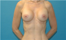 Breast Augmentation After Photo by Scott Sattler, MD,  FACS; Seattle, WA - Case 49227