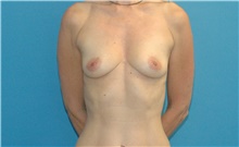 Breast Augmentation Before Photo by Scott Sattler, MD,  FACS; Seattle, WA - Case 49227