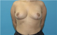 Breast Reduction After Photo by Scott Sattler, MD,  FACS; Seattle, WA - Case 49261