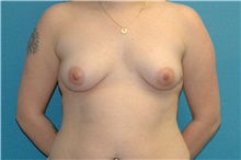 Breast Augmentation Before Photo by Scott Sattler, MD,  FACS; Seattle, WA - Case 49274