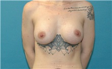 Breast Augmentation After Photo by Scott Sattler, MD,  FACS; ,  - Case 50353