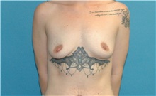Breast Augmentation Before Photo by Scott Sattler, MD,  FACS; ,  - Case 50353
