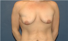 Breast Lift Before Photo by Scott Sattler, MD,  FACS; ,  - Case 50381