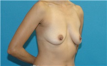 Breast Augmentation Before Photo by Scott Sattler, MD,  FACS; ,  - Case 50440