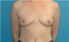 Breast Augmentation Before Photo by Scott Sattler, MD,  FACS; ,  - Case 50437
