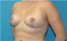 Breast Augmentation After Photo by Scott Sattler, MD,  FACS; ,  - Case 50442