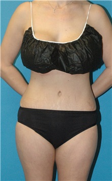 Tummy Tuck After Photo by Scott Sattler, MD,  FACS; ,  - Case 50513