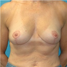 Breast Lift After Photo by Scott Sattler, MD,  FACS; Seattle, WA - Case 50573