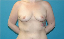 Breast Lift After Photo by Scott Sattler, MD,  FACS; Seattle, WA - Case 50579